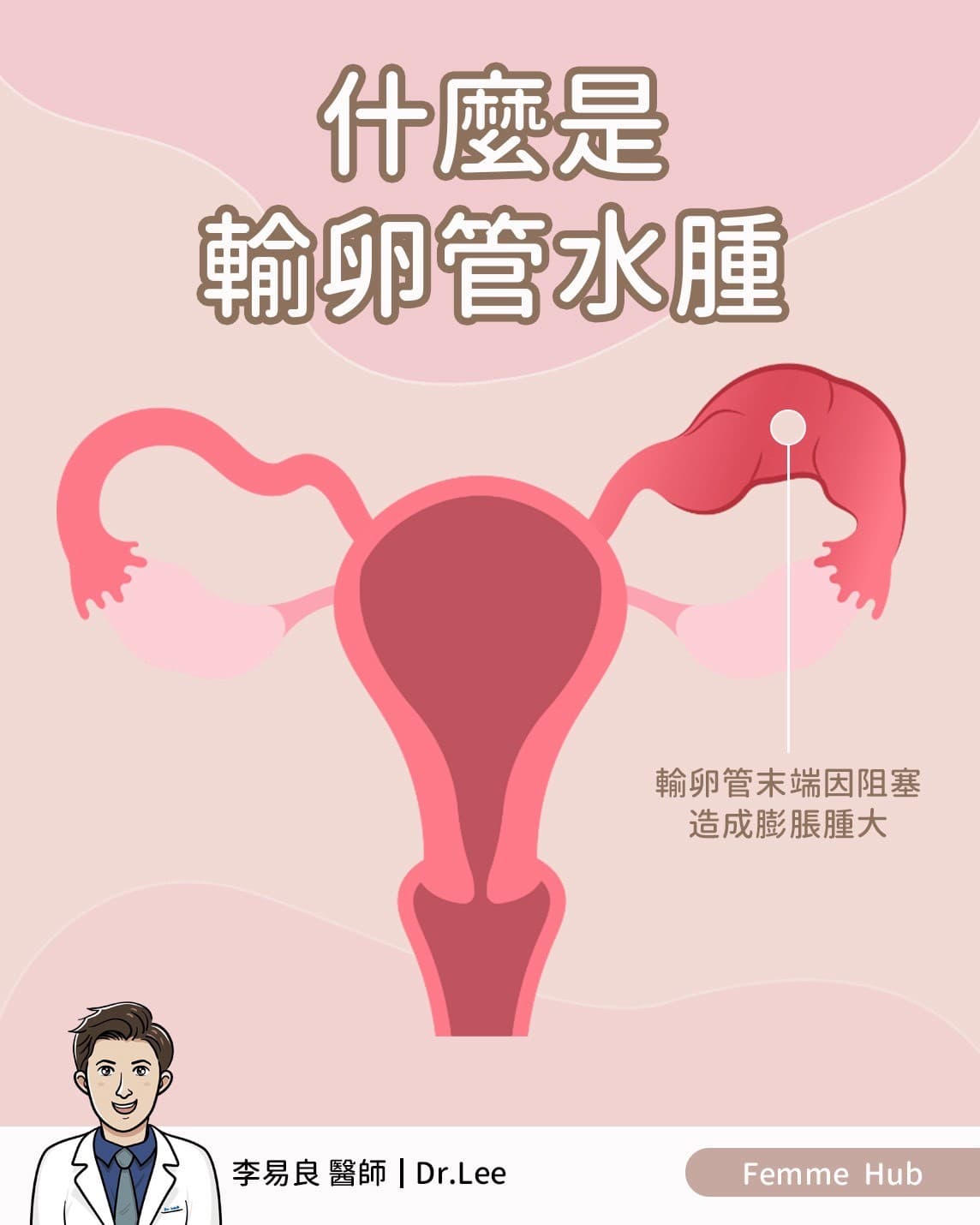 👨🏻⚕什麼是輸卵管水腫(Hydrosalpinx)? 『 上篇 』.jpg