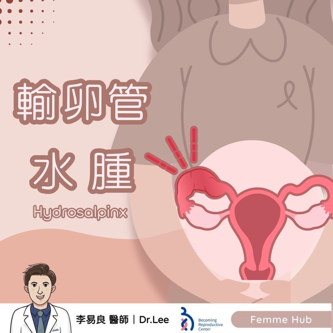 👨🏻⚕什麼是輸卵管水腫(Hydrosalpinx)? 『 下篇 』.jpg