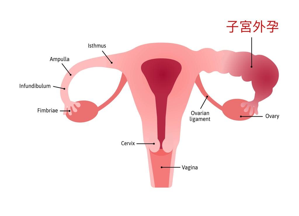 胚胎植入後子宮外孕的風險及MTX藥物治療 .jpg