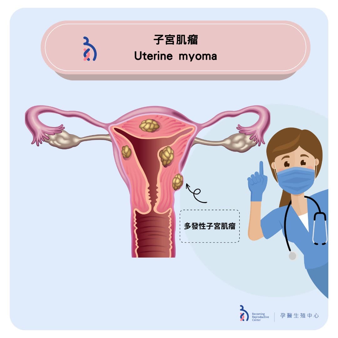 子宮肌瘤與懷孕🤰🏻.jpg