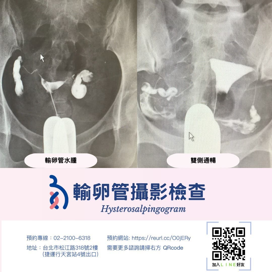 輸卵管攝影檢查 🧐是什麼?.jpg