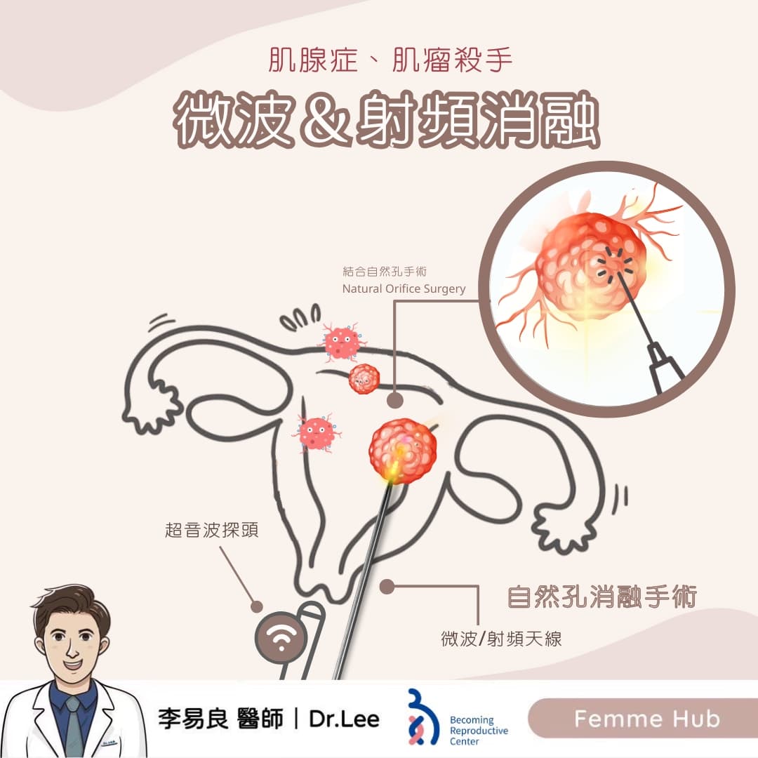 肌腺症及肌瘤殺手.jpg